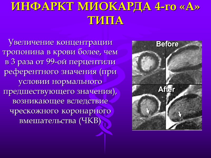 ИНФАРКТ МИОКАРДА 4-го «А» ТИПА Увеличение концентрации тропонина в крови более, чем в 3